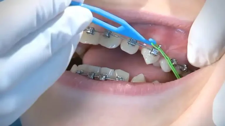 Can You Reuse Rubber Bands for Braces? ANSWERED